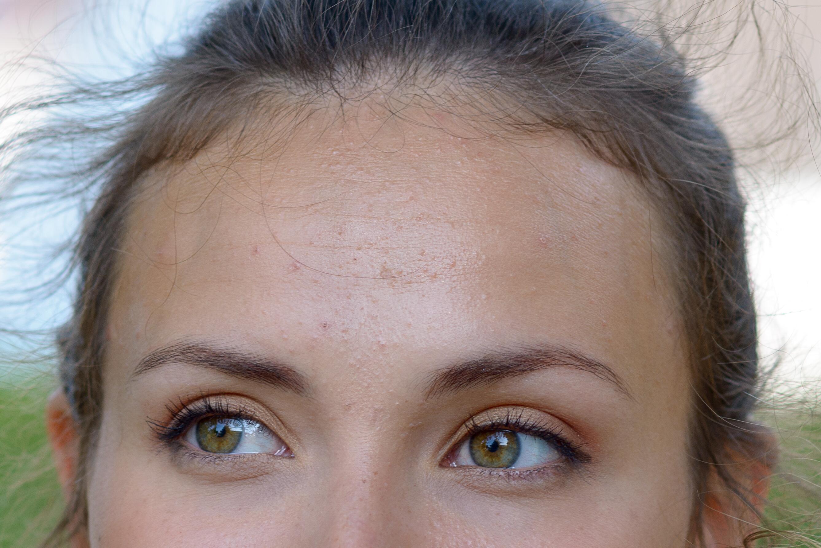 Treatments for mild acne